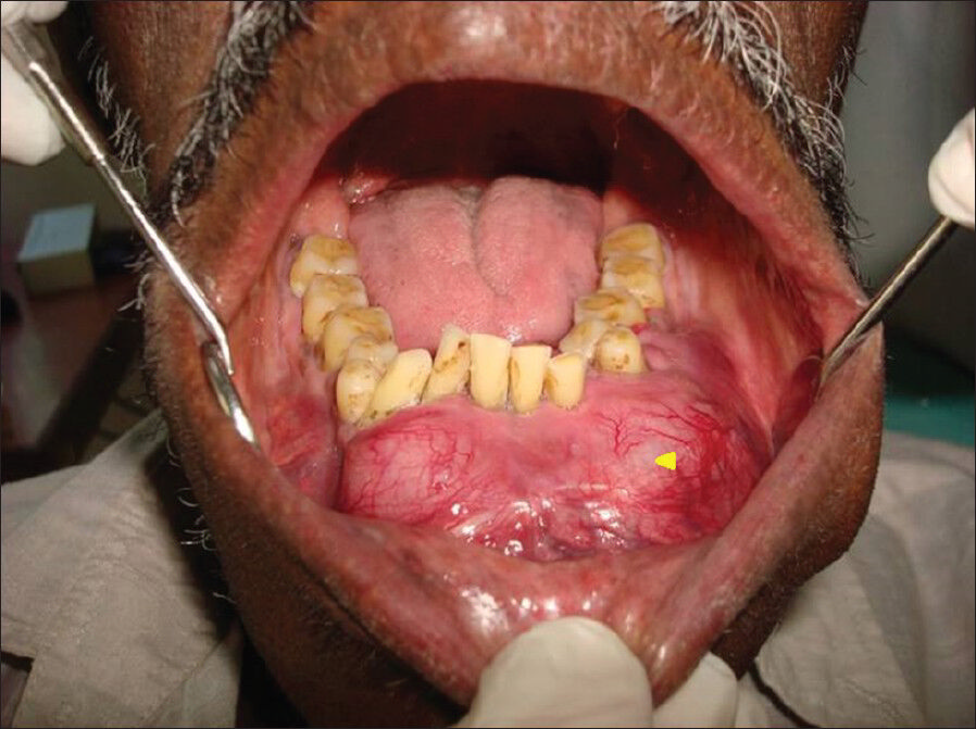 72-year-old male with a swelling in the mandible and the left lower leg, diagnosed with multiple myeloma. Clinical intraoral view from the front, shows diffuse swelling extending from the left lower second molar to the right lower first molar region, obliterating the buccal and the lingual vestibule (arrowhead).